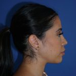 Browlift Before & After Patient #10001