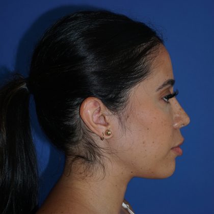 Browlift Before & After Patient #10001