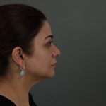 Regenelift™ Facelift Before & After Patient #9788