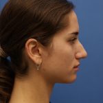 Rhinoplasty Before & After Patient #9790