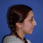 Rhinoplasty Before & After Patient #9791