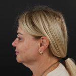 Regenelift™ Facelift Before & After Patient #9793