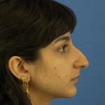 Rhinoplasty Before & After Patient #9986