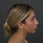 Rhinoplasty Before & After Patient #9987