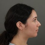Rhinoplasty Before & After Patient #9988
