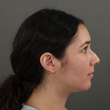 Rhinoplasty Before & After Patient #9988