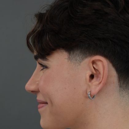 Rhinoplasty Before & After Patient #9989