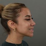 Rhinoplasty Before & After Patient #9990