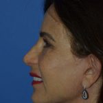 Regenelift™ Facelift Before & After Patient #9993