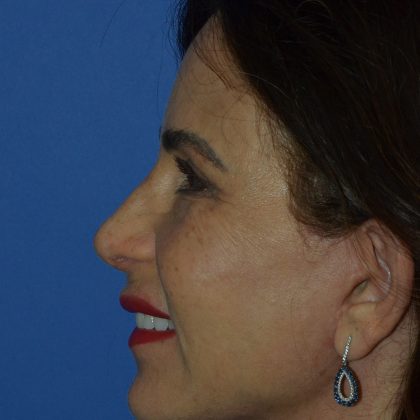 Regenelift™ Facelift Before & After Patient #9993