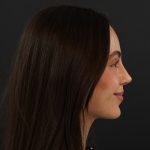 Rhinoplasty Before & After Patient #9783