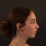 Rhinoplasty Before & After Patient #9996