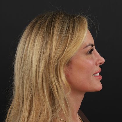 Rhinoplasty Before & After Patient #9997