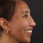 Regenelift™ Facelift Before & After Patient #9998