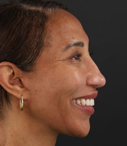 Regenelift™ Facelift Before & After Patient #9998