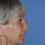 Regenelift™ Facelift Before & After Patient #9786