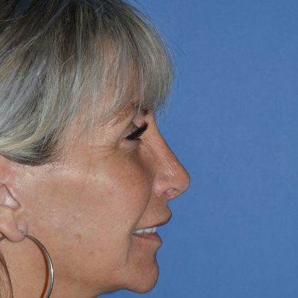 Regenelift™ Facelift Before & After Patient #9786