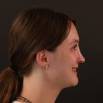 Rhinoplasty Before & After Patient #10000
