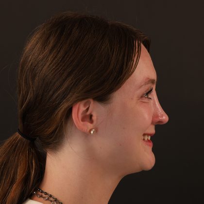 Rhinoplasty Before & After Patient #10000