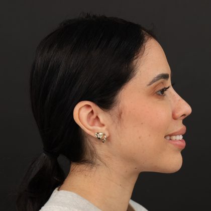 Browlift Before & After Patient #10001
