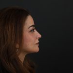 Regenelift™ Facelift Before & After Patient #9788
