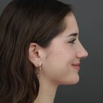 Rhinoplasty Before & After Patient #9790