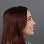 Rhinoplasty Before & After Patient #9791
