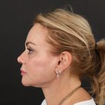 Regenelift™ Facelift Before & After Patient #9793