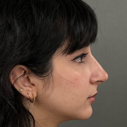 Rhinoplasty Before & After Patient #9986