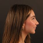 Rhinoplasty Before & After Patient #9987