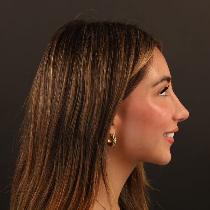 Rhinoplasty Before & After Patient #9987