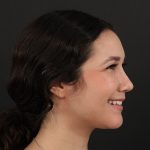 Rhinoplasty Before & After Patient #9988