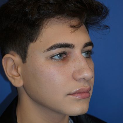 Rhinoplasty Before & After Patient #9989