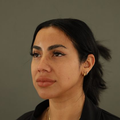 Rhinoplasty Before & After Patient #9990