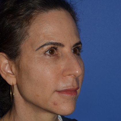 Regenelift™ Facelift Before & After Patient #9993
