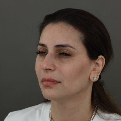 Rhinoplasty Before & After Patient #9994