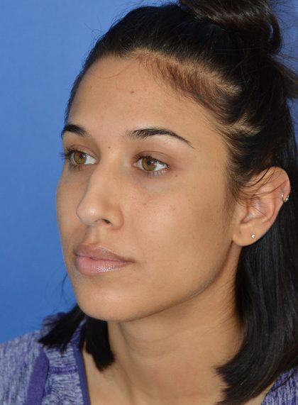 Rhinoplasty Before & After Patient #9995