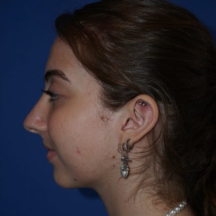 Rhinoplasty Before & After Patient #9996