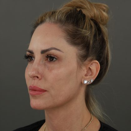 Rhinoplasty Before & After Patient #9997