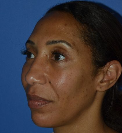 Regenelift™ Facelift Before & After Patient #9998