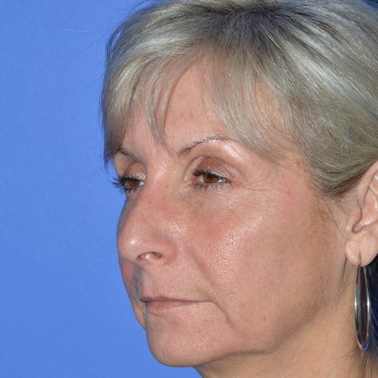 Regenelift™ Facelift Before & After Patient #9786