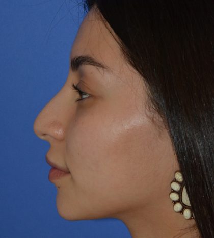 Rhinoplasty Before & After Patient #9999