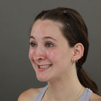 Rhinoplasty Before & After Patient #10000