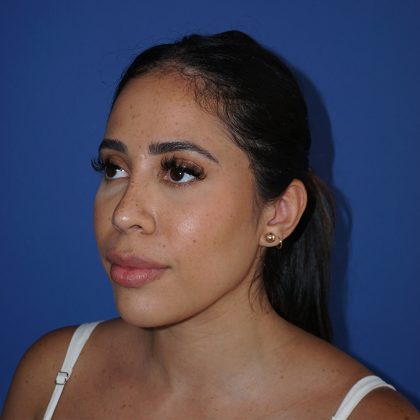 Browlift Before & After Patient #10001
