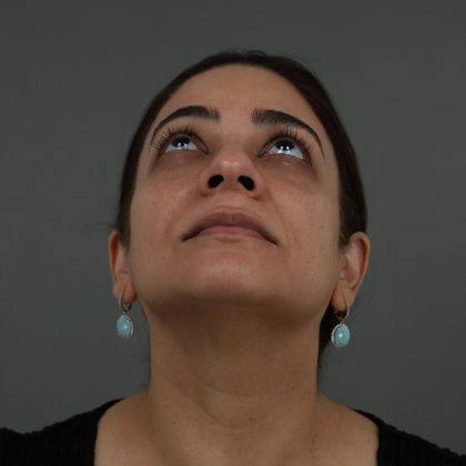 Regenelift™ Facelift Before & After Patient #9788