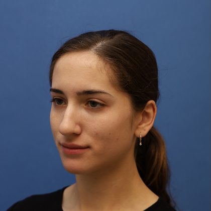 Rhinoplasty Before & After Patient #9790