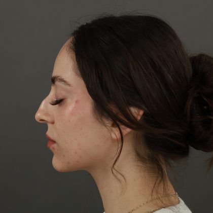 Rhinoplasty Before & After Patient #9783