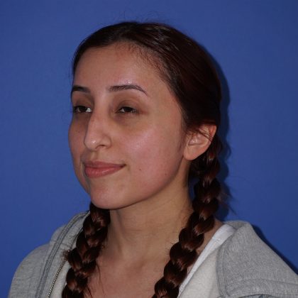 Rhinoplasty Before & After Patient #9791