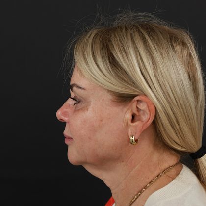 Regenelift™ Facelift Before & After Patient #9793