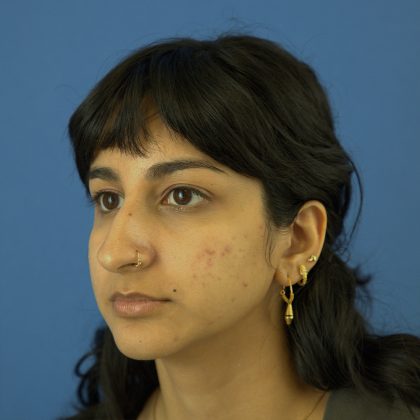 Rhinoplasty Before & After Patient #9986